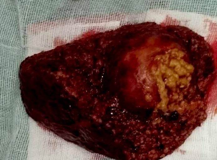 图5-7 切开的肝脏肿瘤.jpg