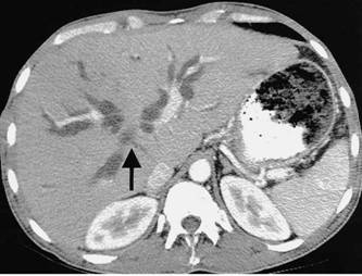 图7-17 胆管癌CT 显像1.jpg
